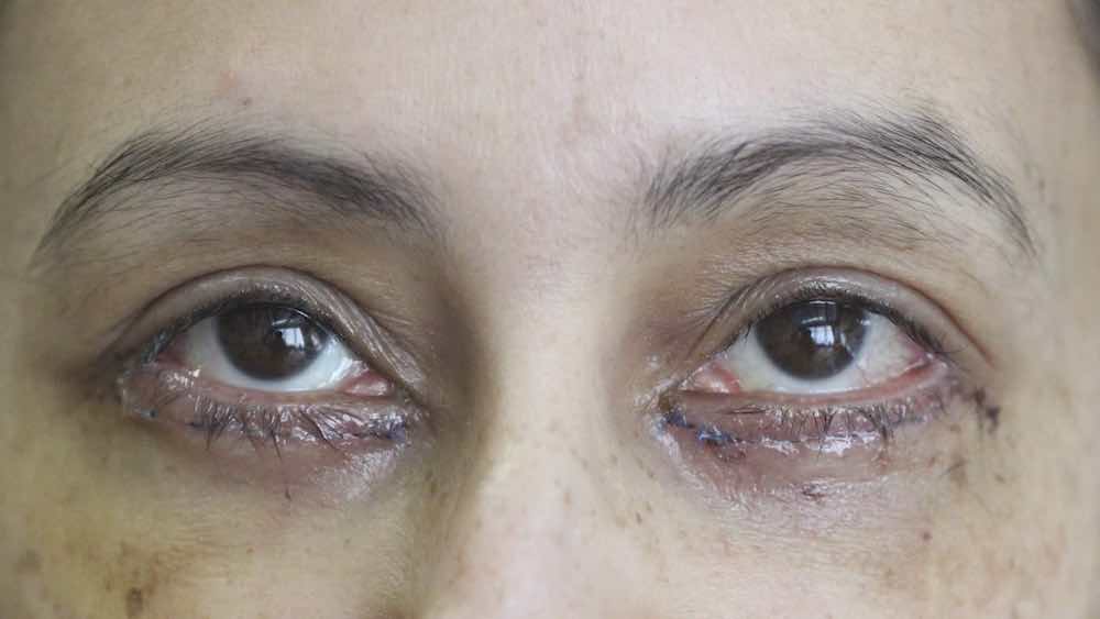 Eyebag removal & Cosmetic Eyelid Surgery Birmingham Mr David Cheung