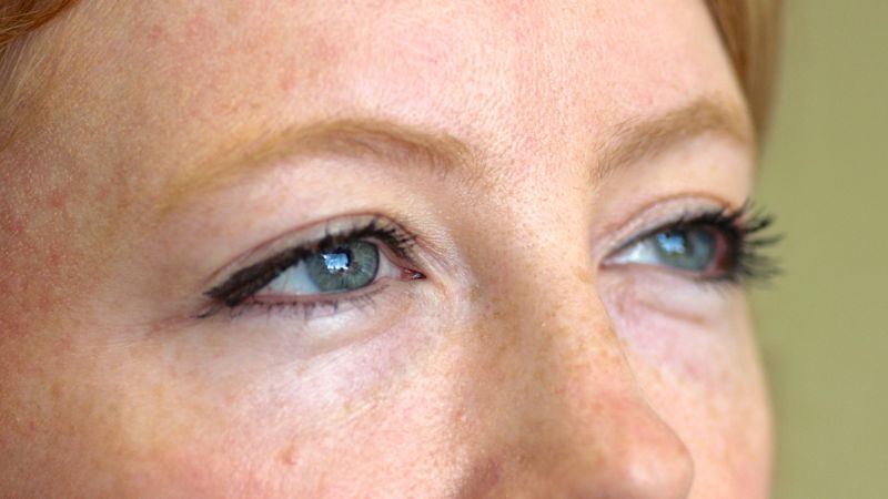 2 weeks after injection of Restylane in to the tear trough. Notice the increased fullness to the tear trough. The filler helps camouflage the bulge of the lower lid caused by prolapsing fat pads. One can see why this procedure is sometimes termed a ‘non-surgical blepharoplasty’
