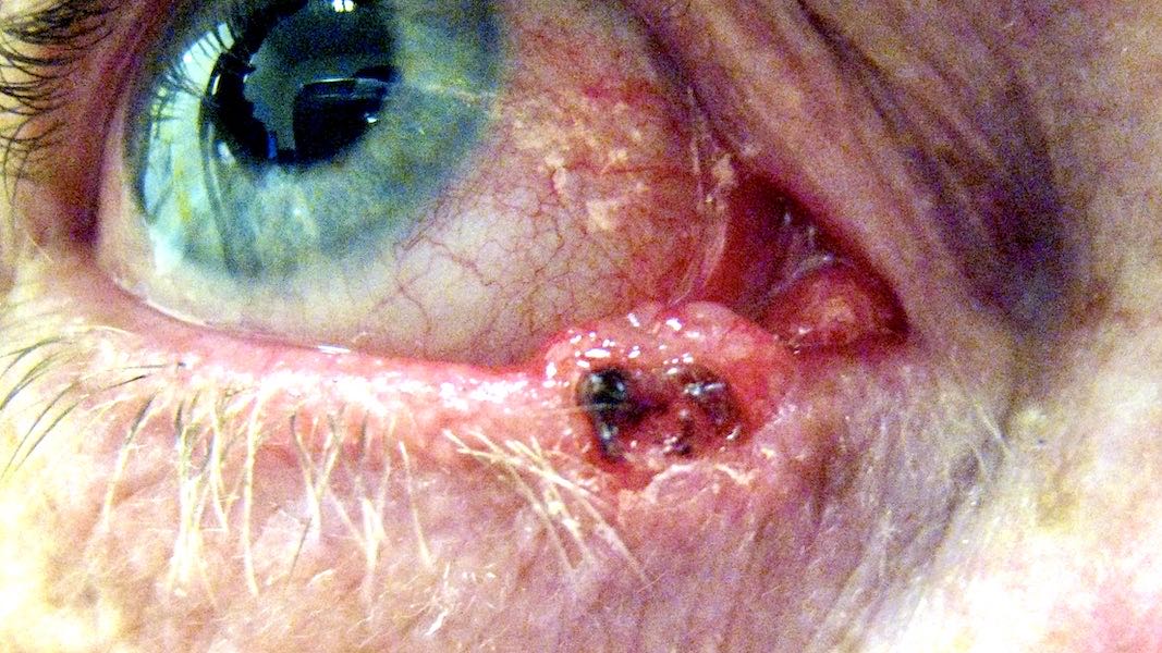 This skin cancer had been slowly growing for 6 months