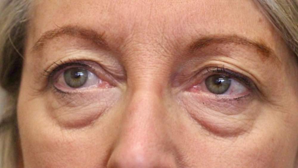 before upper lower blepharoplasty picture 4