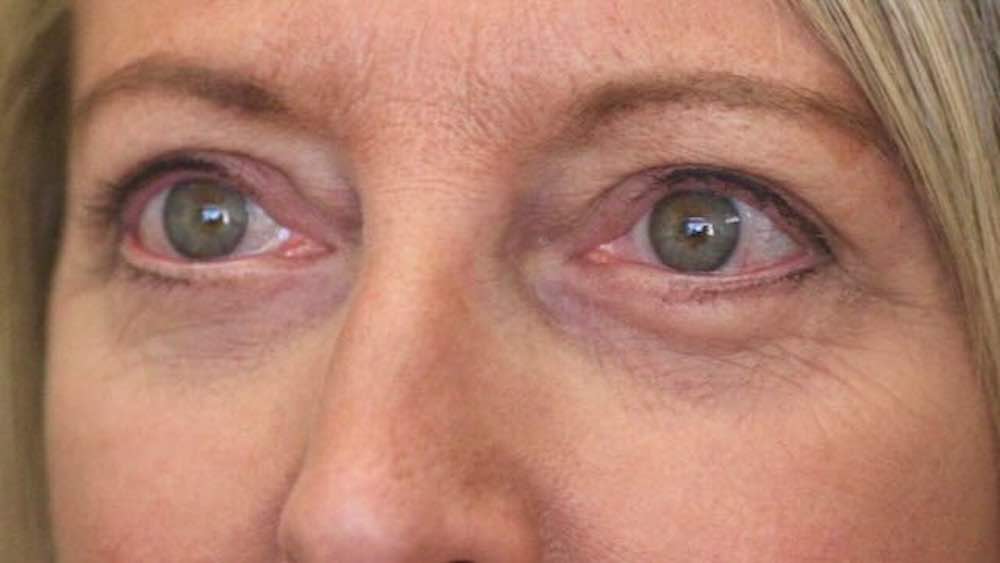 after upper and lower blepharoplasty picture