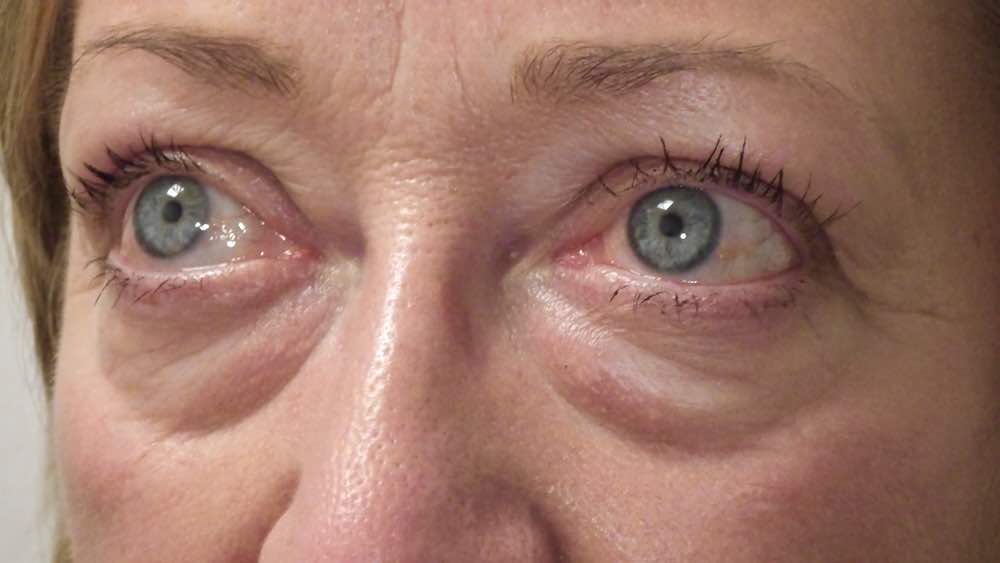 before upper blepharoplasty 2