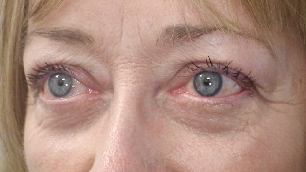 after ptosis blepharoplasty 2