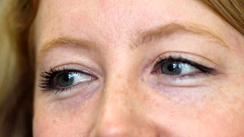 2 weeks after injection of Restylane in to the tear trough. Notice the increased fullness to the tear trough. The filler helps camouflage the bulge of the lower lid caused by prolapsing fat pads. One can see why this procedure is sometimes termed a ‘non-surgical blepharoplasty’