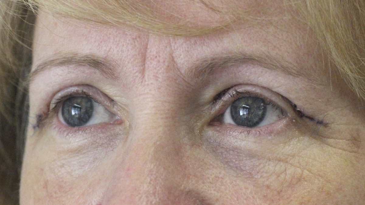 after internal browpexy blepharoplasty