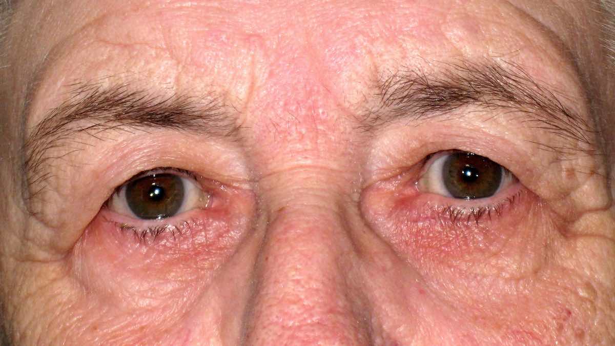 Before endotine transblepharoplasty brow lifting