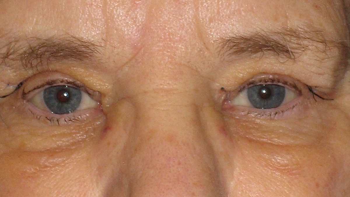 after internal browpexy surgery