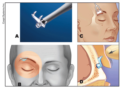 Endotine Transblepharoplasty Implants