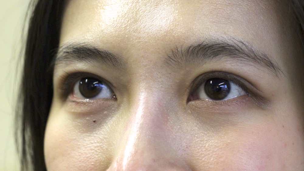 Double Eyelid surgery UK