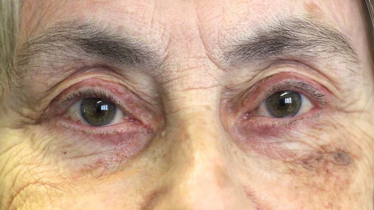 After Ptosis Surgery