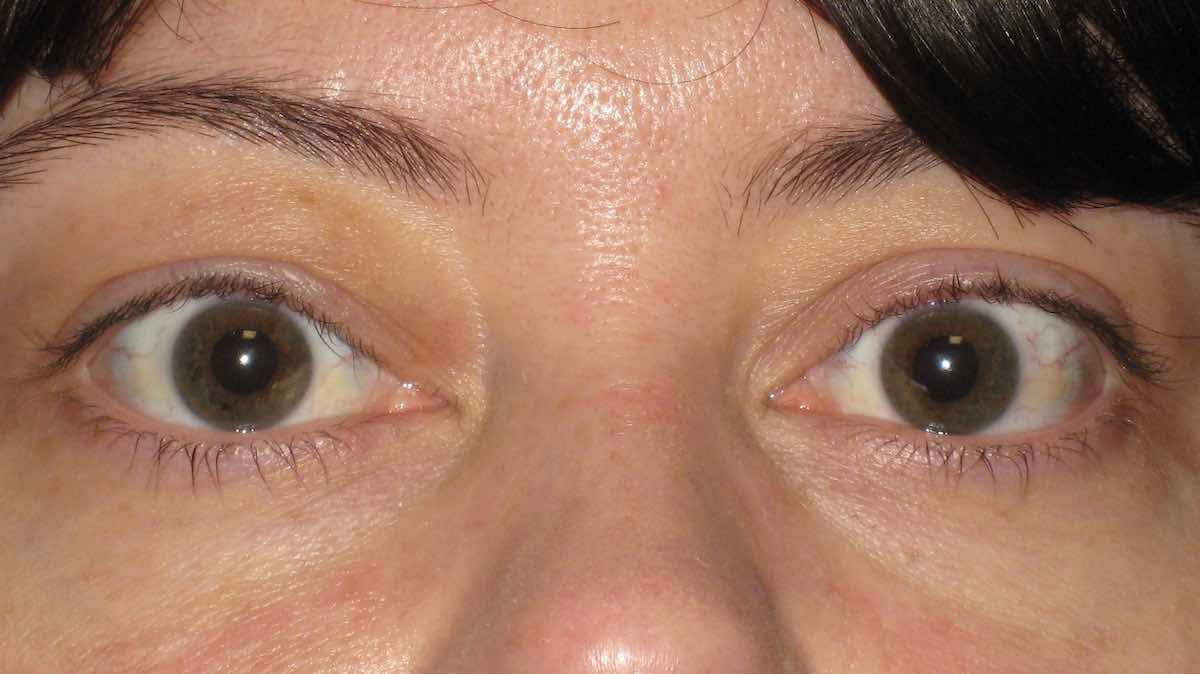 4 weeks following drooping ptosis eyelid correction