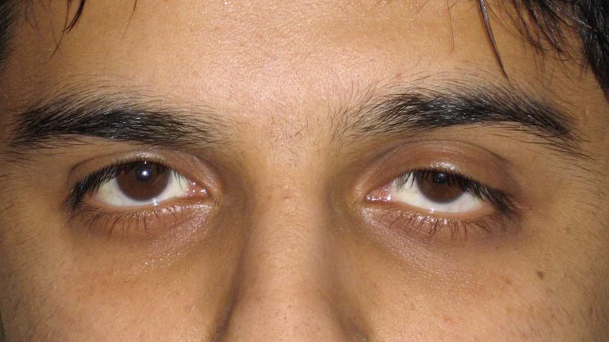 contact lenses causing drooping eyelid