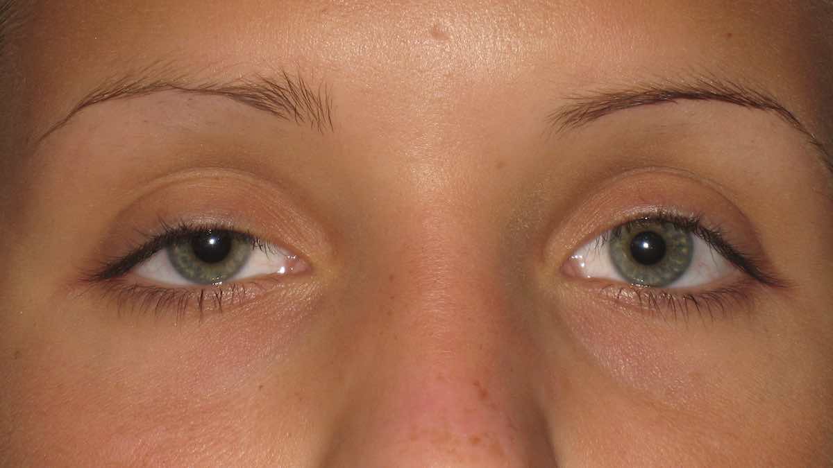 before drooping eyelid surgery