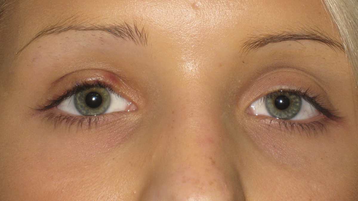 1 week after drooping eyelid surgery