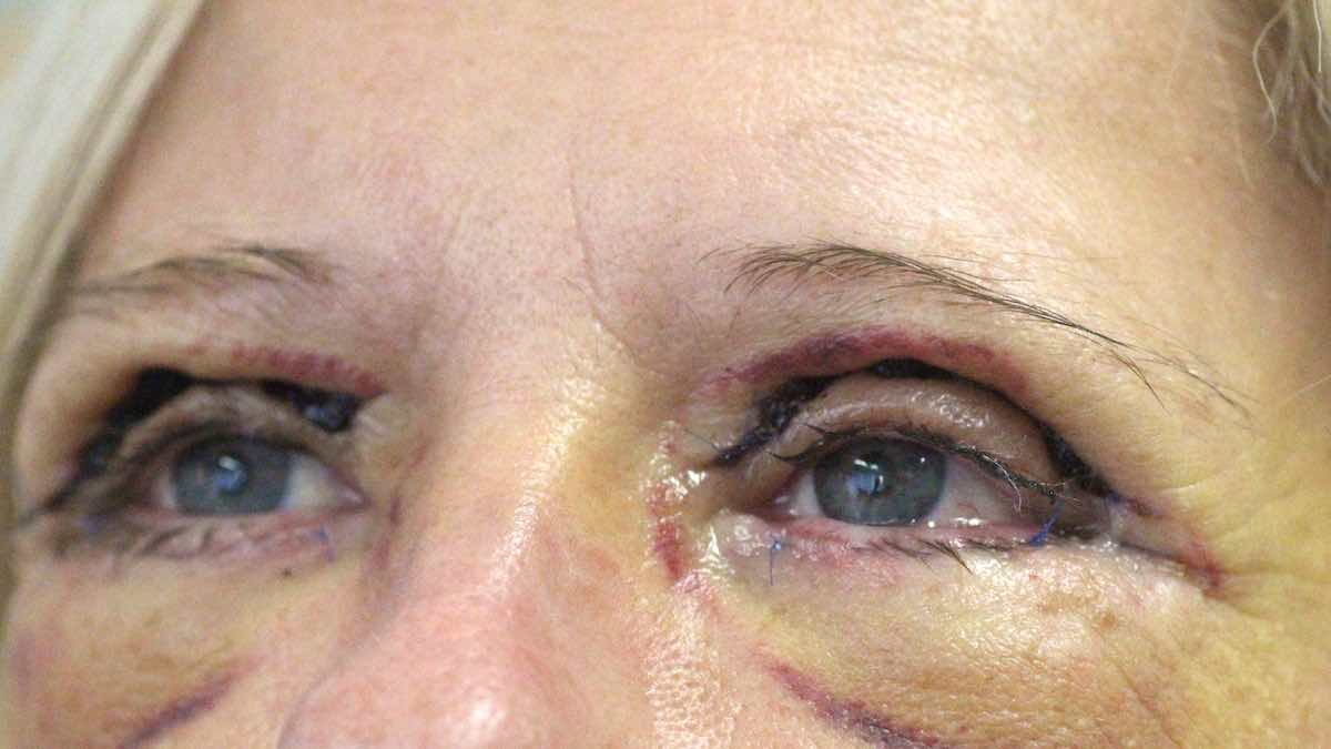 1 week after bilateral ptosis correction surgery