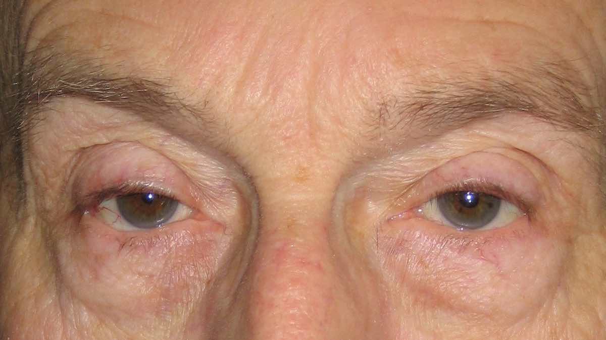 before ptosis correction surgery