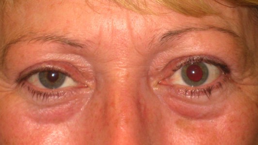 Complex simultaneous eyelid elevation and lower surgery