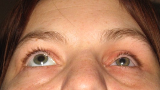 Post Enucleation Socket Syndrome: Before treatment with filler injections. Note how sunken the left (her left) artificial eye has become through many years of wearing an artificial eye. 