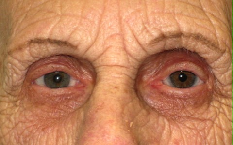4 months after removal of her left eye. Note the articial eye looks so realistic that it is almost identical. 