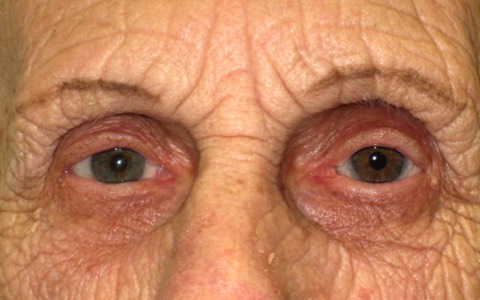 4 months after removal of her left eye. Note the articial eye looks so realistic that it is almost identical. 