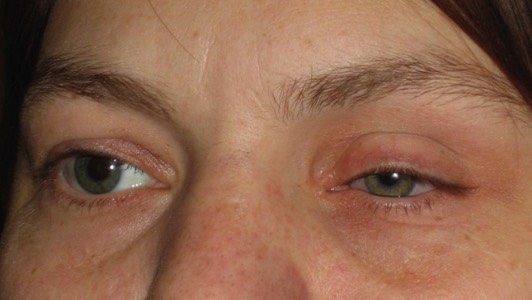 Post Enucleation Socket Syndrome: Before treatment with filler injections. Note how sunken the left (her left) artificial eye has become through many years of wearing an artificial eye. 