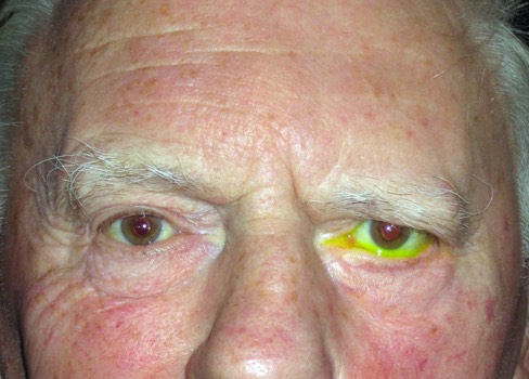 Typical features of long term facial nerve palsy on the patient