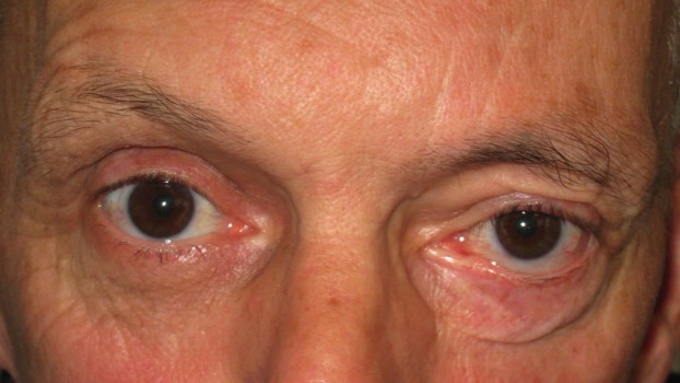 This weight is perfectly sized for the patient- aiding closure of the eye without causing a droopy eyelid