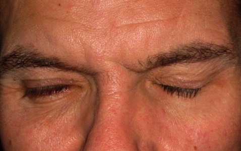 Incomplete recovery of Bells Palsy