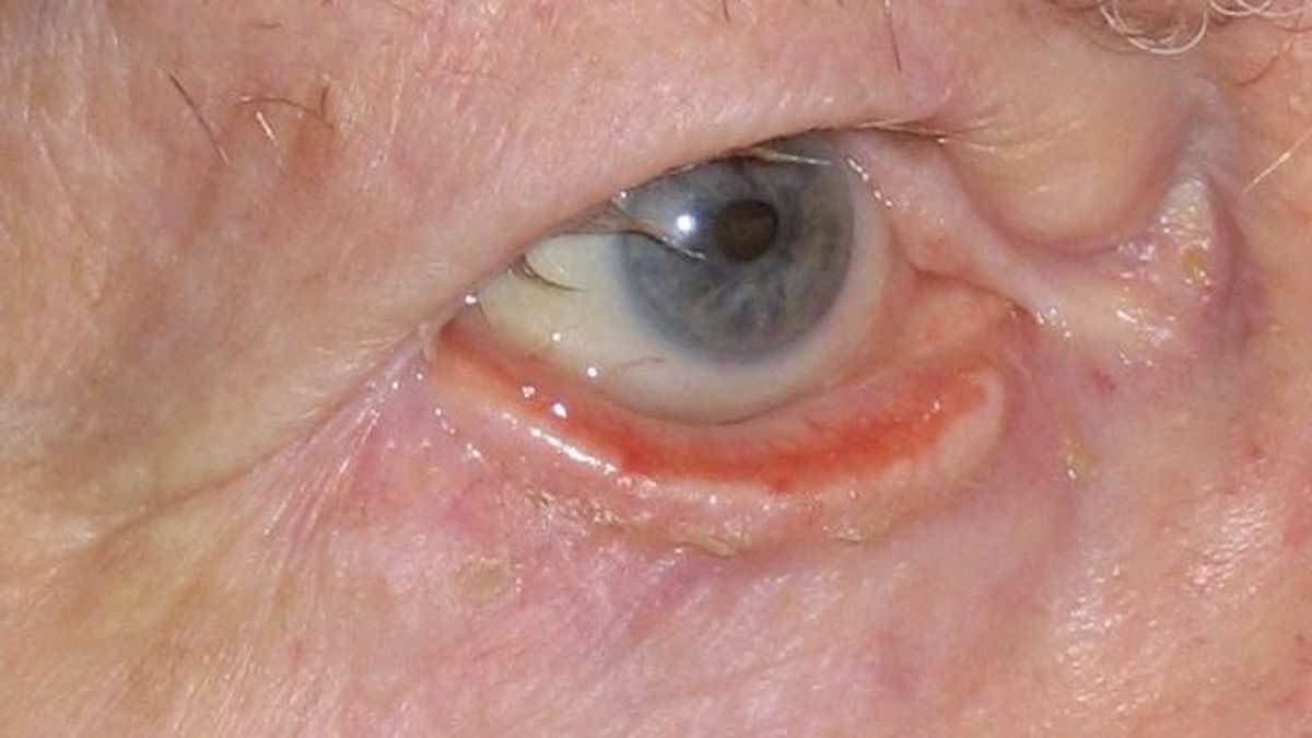 Ectropion Eyelids turning outwards Mr David Cheung Eyelid Specialist Birmingham UK