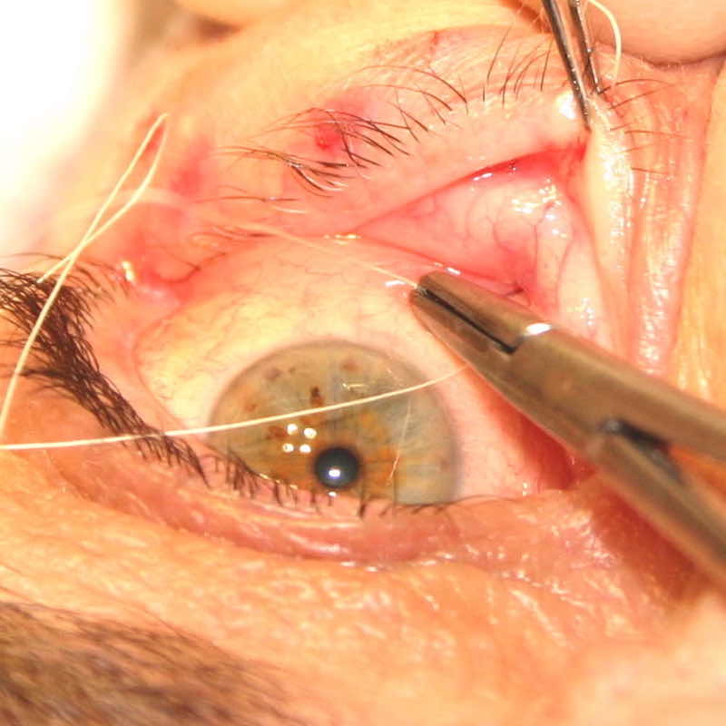Sutures are inserted to tighten up the lower eyelid