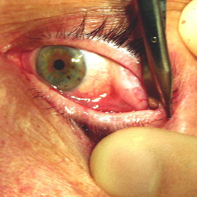 The lateral canthal tendon is detached off