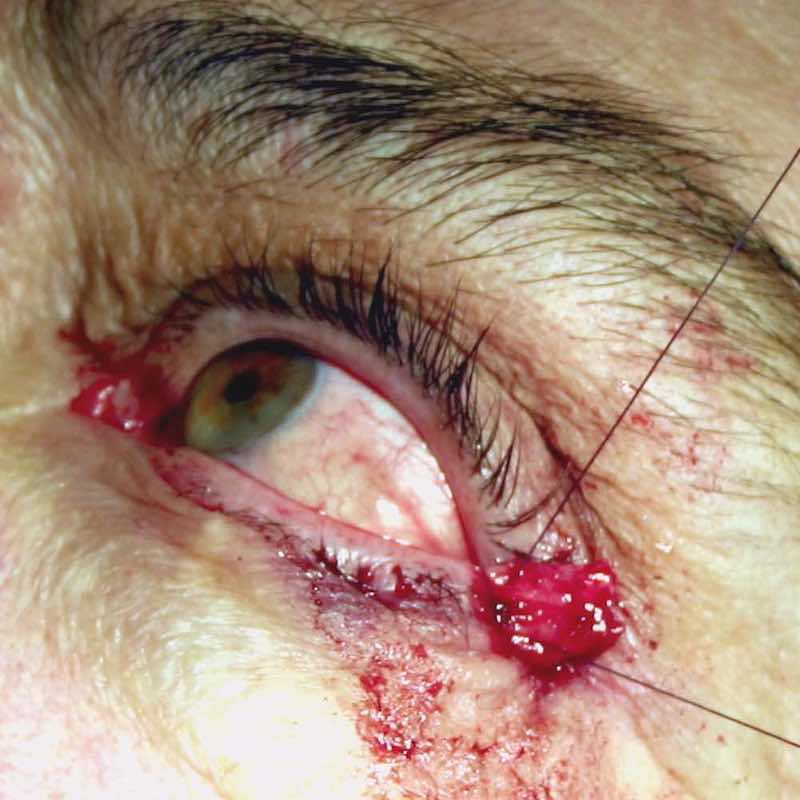 This lateral canthal  tendon is tightened up with sutures. 