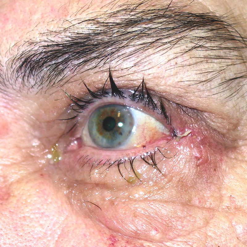 1 week following surgery