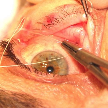 Sutures are inserted to tighten up the lower eyelid
