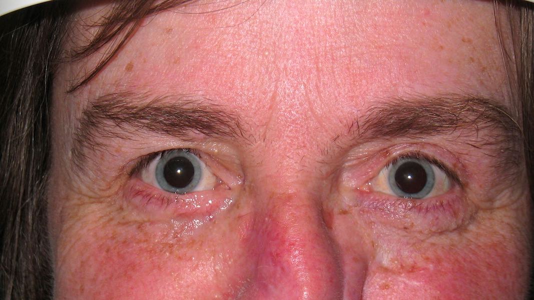 After 2 weeks, the Hughes flap is opened with surgery. The patient can open her eyelids normally and is pleased with the cosmetic result. 