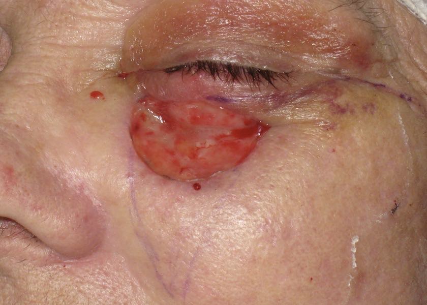 The resultant skin defect following removal of the skin cancer. This defect is going to be closed using a large sliding skin flap. 