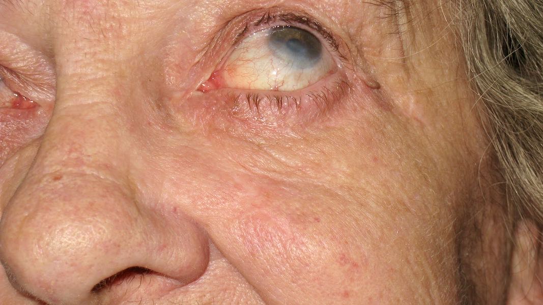 4 months following surgery. The flap has become invisible. The patient is very happy with the cosmetic and functional result. 