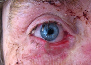 Resultant defect in eyelid after surgery to remove the cancer first