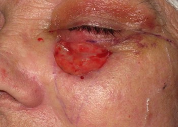 The resultant skin defect following removal of the skin cancer. This defect is going to be closed using a large sliding skin flap. 