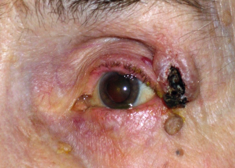 Basal cell carcinoma (BCC): Note the central ulcer, hence their common name - rodent ulcer