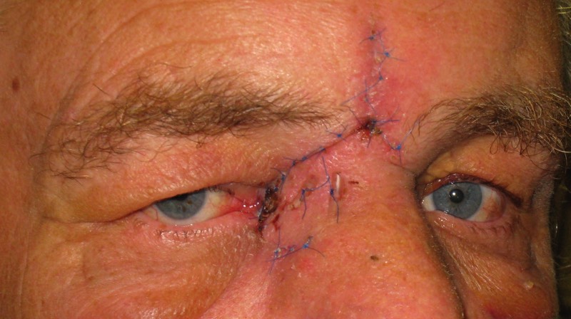 1 week following oculoplastic surgical reconstruction using a flap of skin mobilised from the central forehead (glabellar flap)