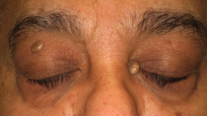 Sebaceous cysts: These white oil filled glands can enlarge to become a cosmetic nuisance