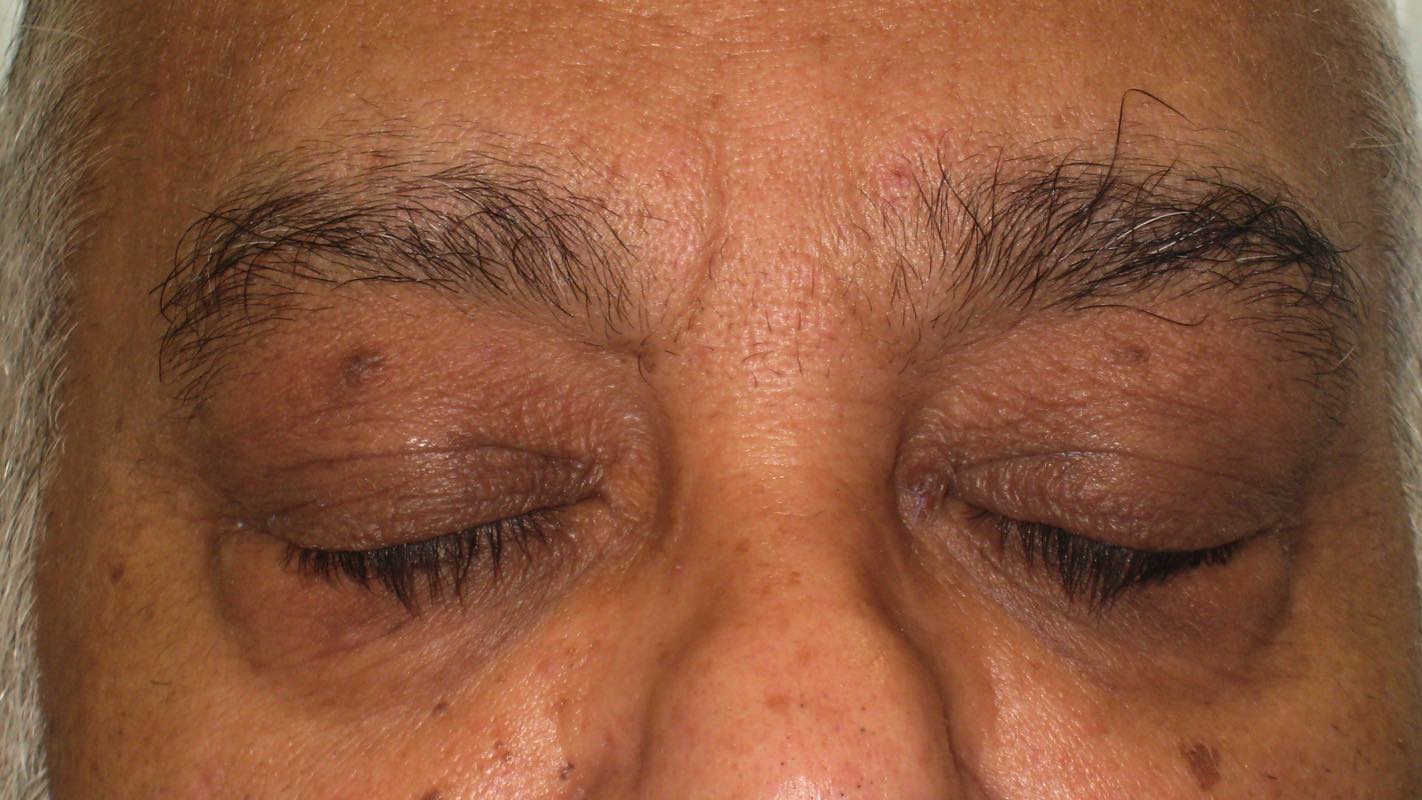 Treatment for lump inside eyelid, chalazion, eyelid cyst Mr David Cheung Eyelid Specialist