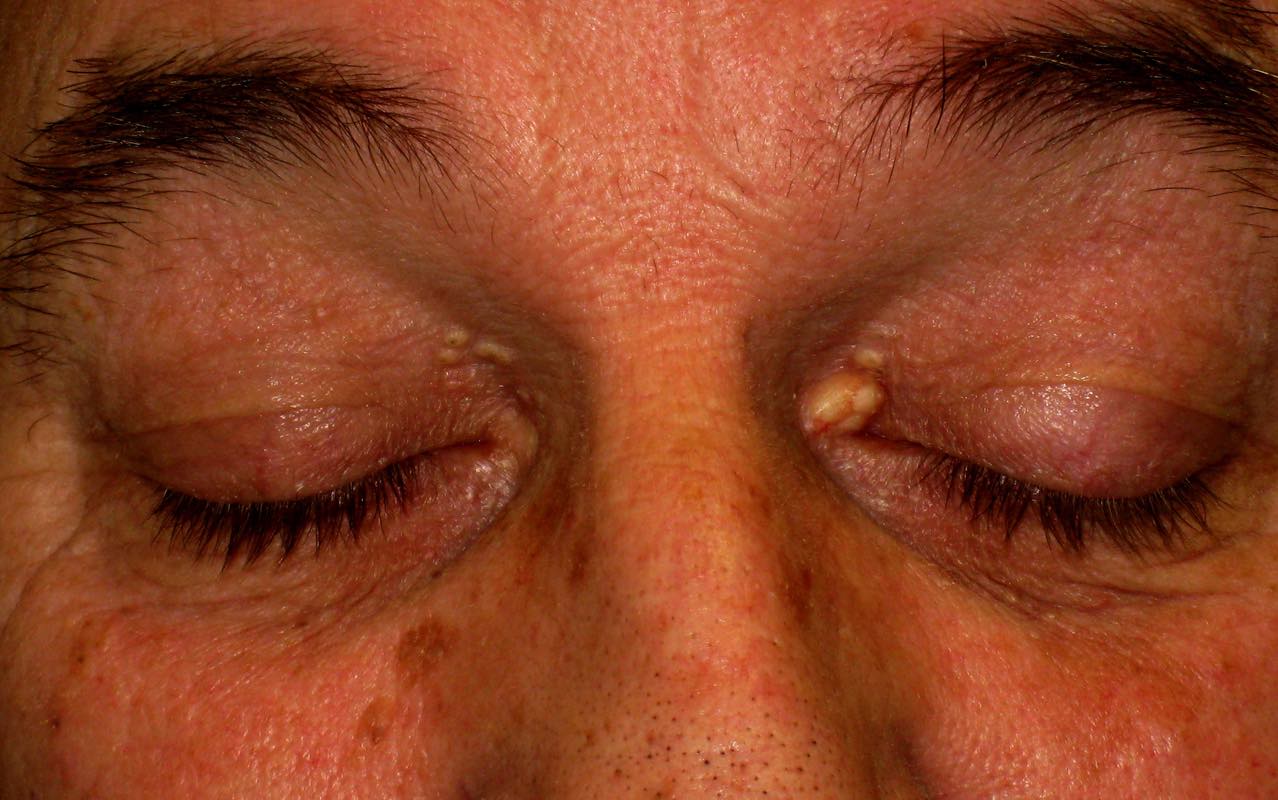 Treatment for lump inside eyelid, chalazion, eyelid cyst