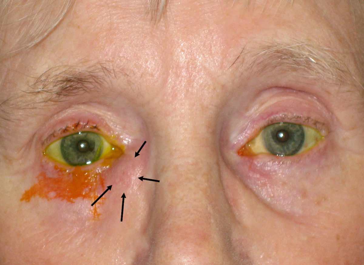 Watering Eyes Watery Eyes Blocked Tear Duct Surgery Mr David Cheung Eyelid Specialist