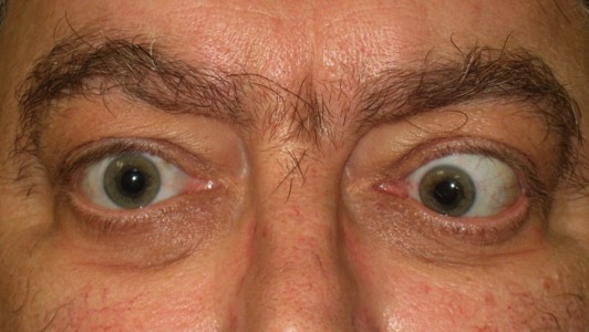 Severe Thyroid Eye Disease