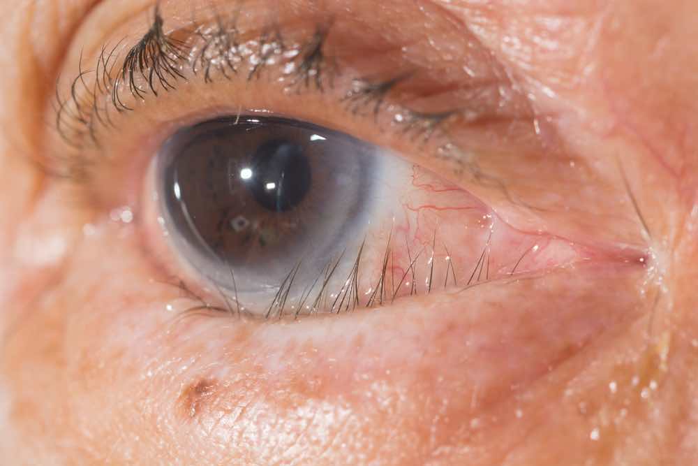 Trichiasis Eyelashes touching eye treatment Mr David Cheung